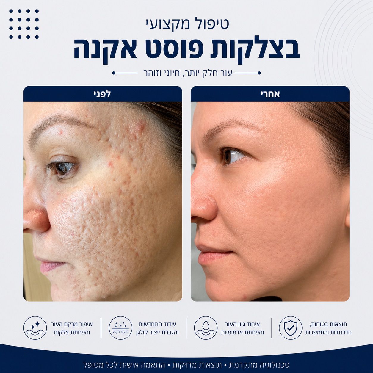 לפני ואחרי טיפול בצלקות פוסט אקנה - Beauty Hightech
