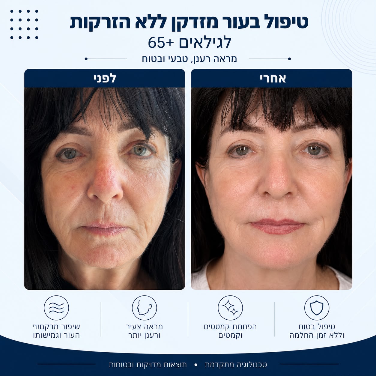 לפני ואחרי טיפול בעור מזדקן ללא הזרקות לגילאי 65 פלוס - Beauty Hightech