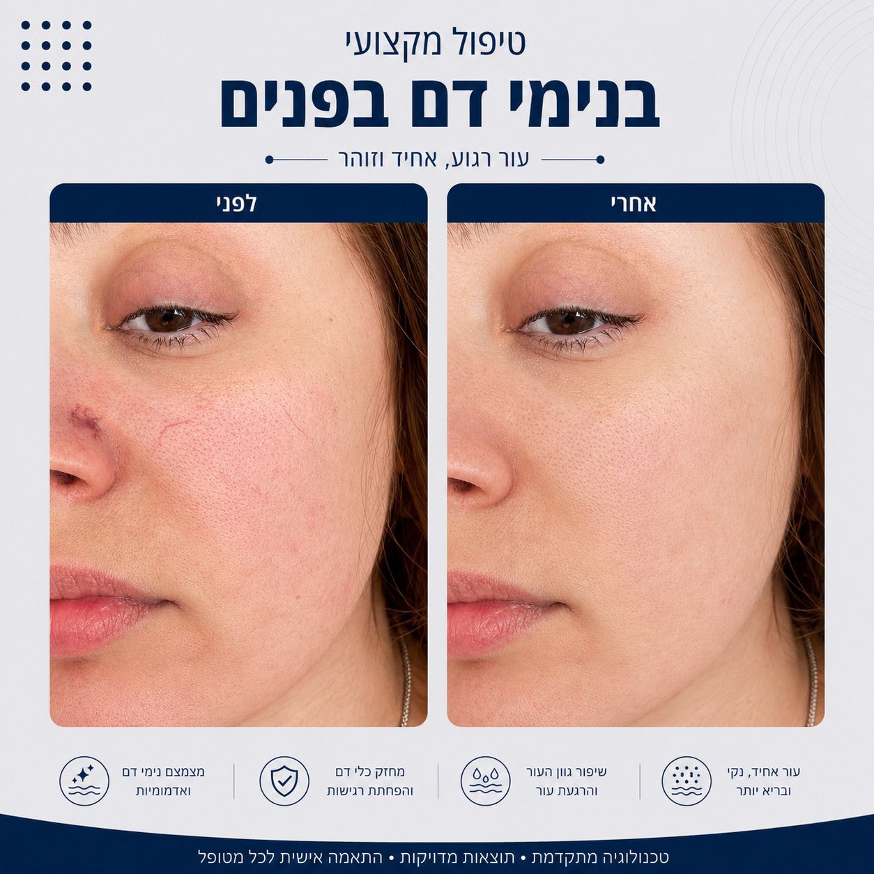 לפני ואחרי טיפול בנימי דם בפנים - Beauty Hightech