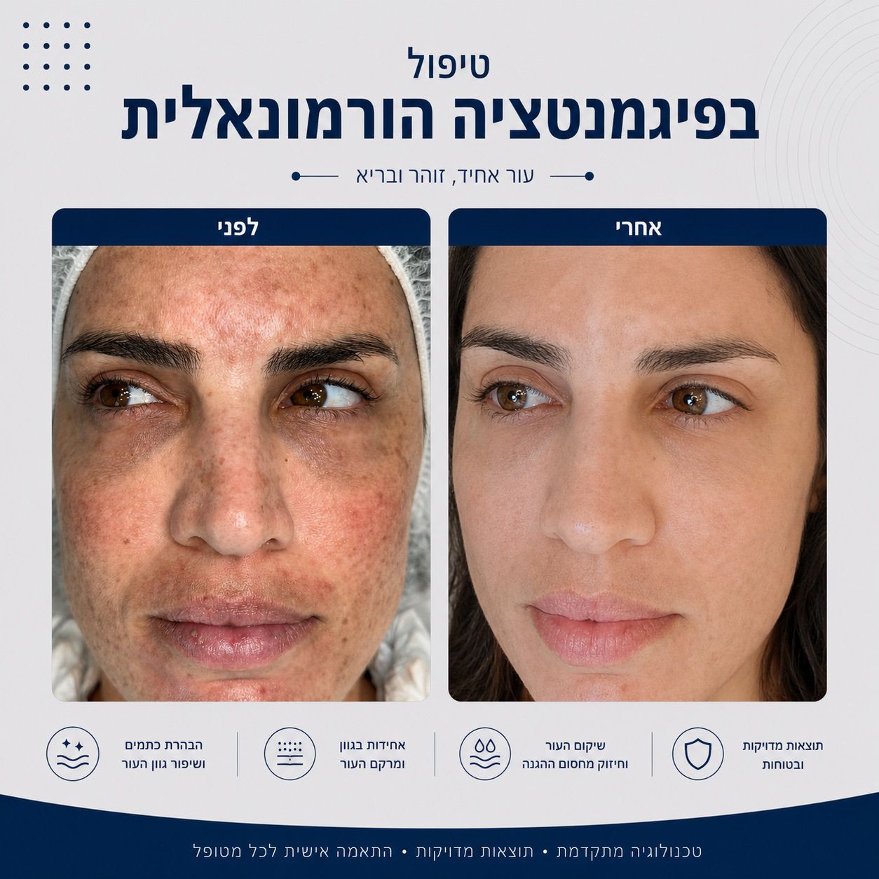 לפני ואחרי טיפול בפיגמנטציה הורמונאלית - Beauty Hightech