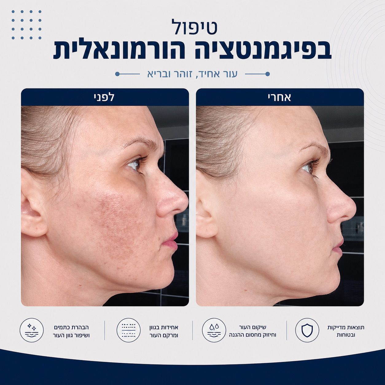 לפני ואחרי טיפול בפיגמנטציה הורמונאלית - Beauty Hightech