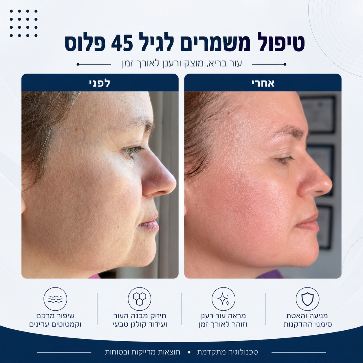 לפני ואחרי טיפול משמרים לגיל 45 פלוס - Beauty Hightech