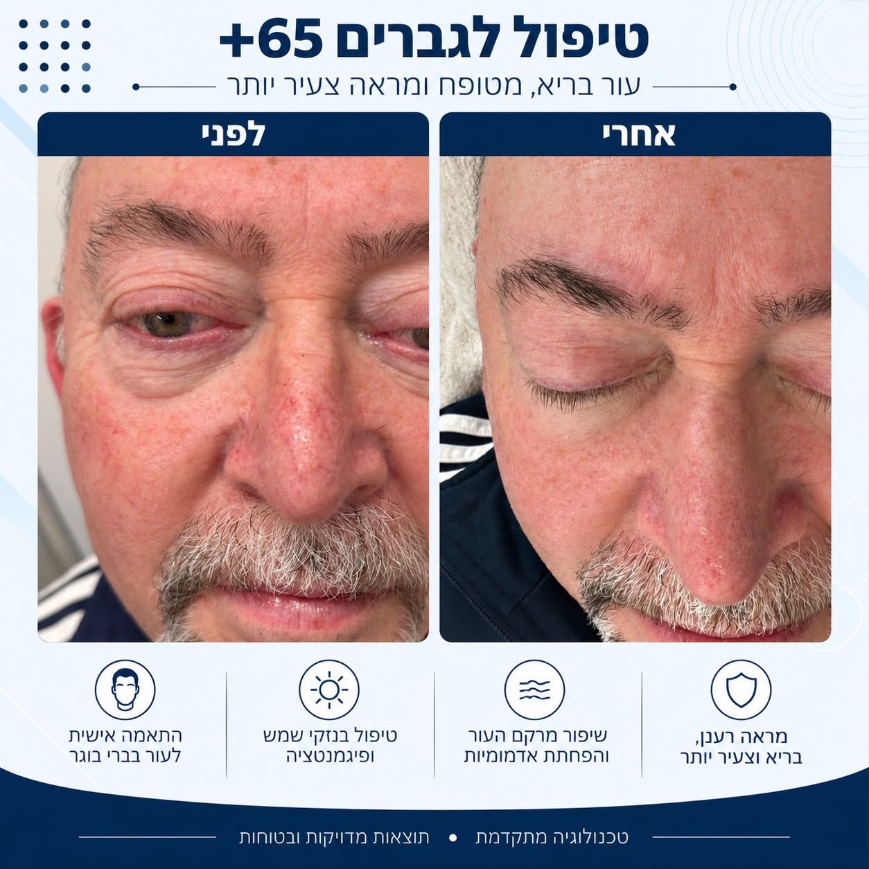 לפני ואחרי טיפול לגברים 65 פלוס - Beauty Hightech