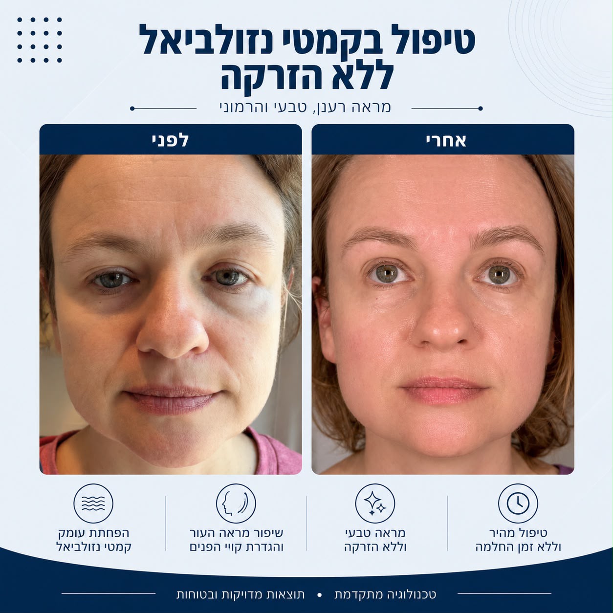לפני ואחרי טיפול בקמטי נזוליאביאל ללא הזרקה - Beauty Hightech