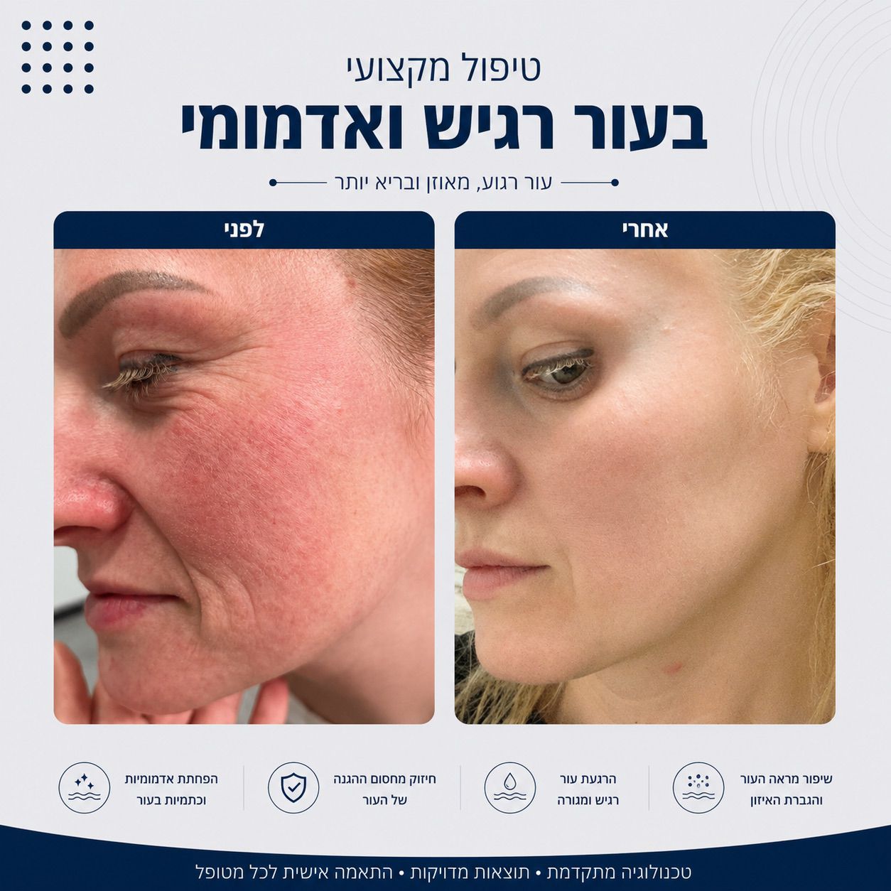 לפני ואחרי טיפול בעור רגיש ואדמומי - Beauty Hightech