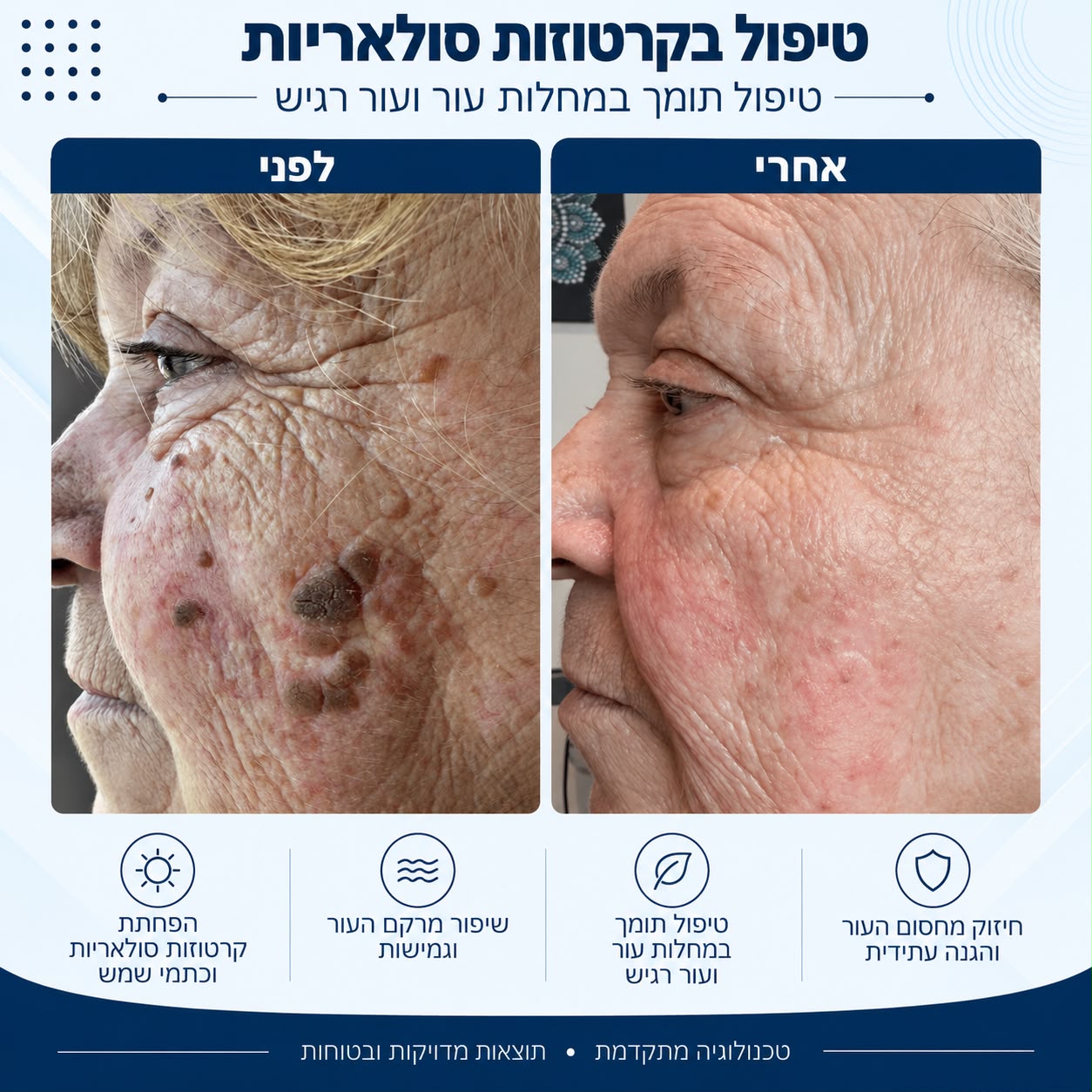 לפני ואחרי טיפול בקרטוזות סולאריות - Beauty Hightech