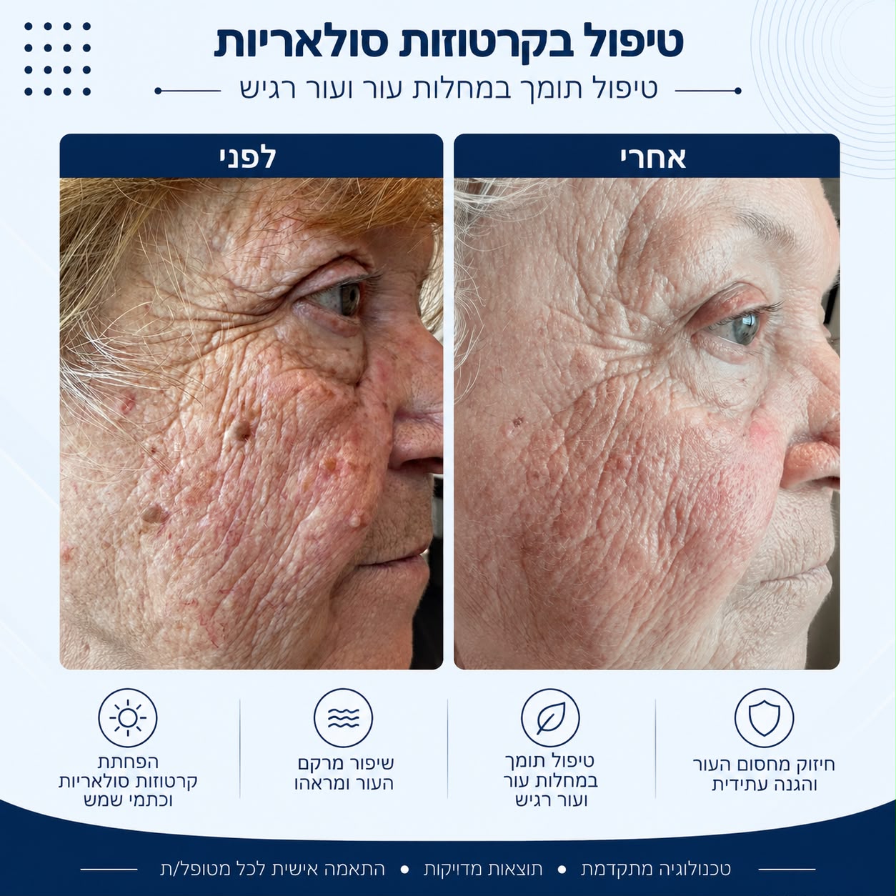 לפני ואחרי טיפול בקרטוזות סולאריות - Beauty Hightech