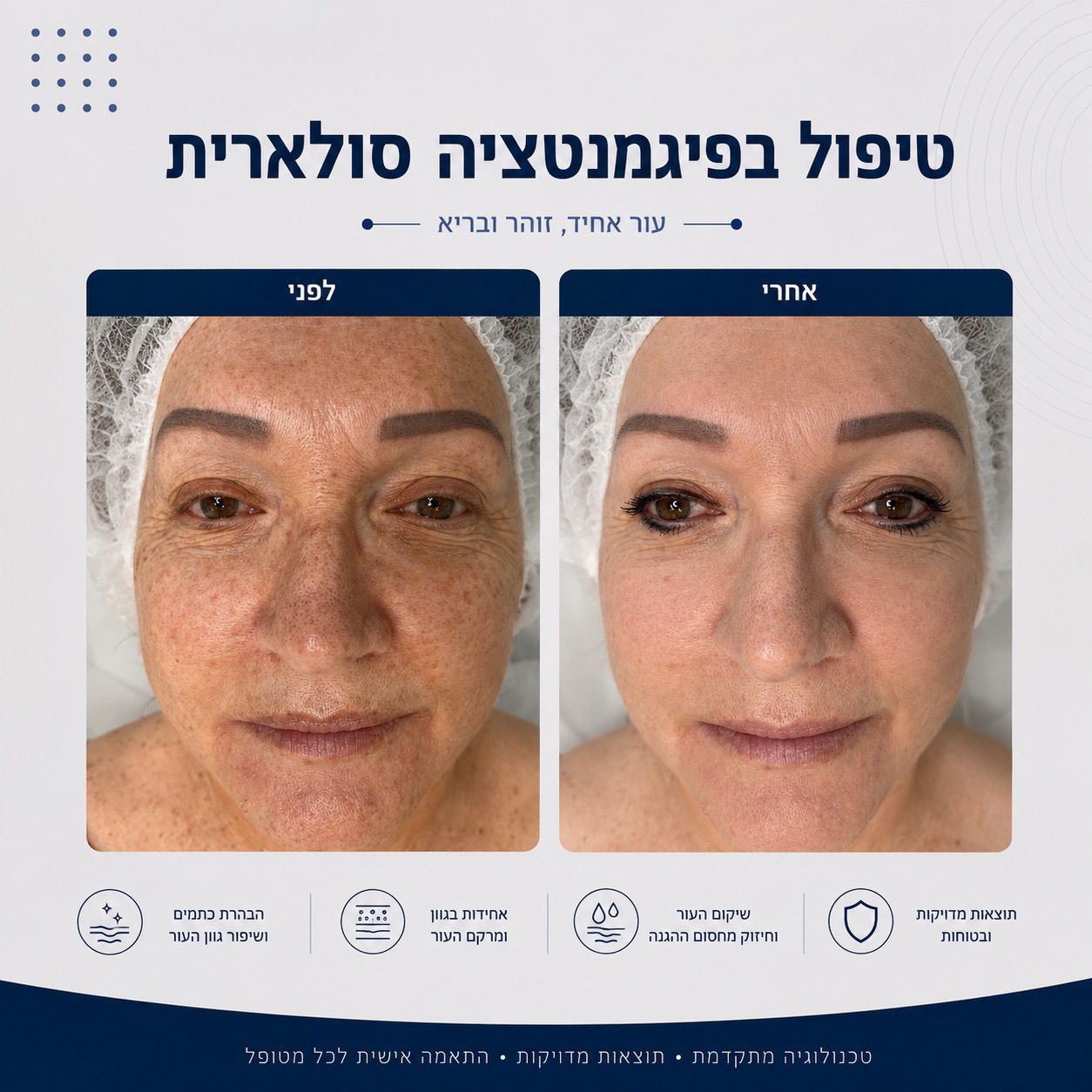 לפני ואחרי טיפול בפיגמנטציה סולארית - Beauty Hightech