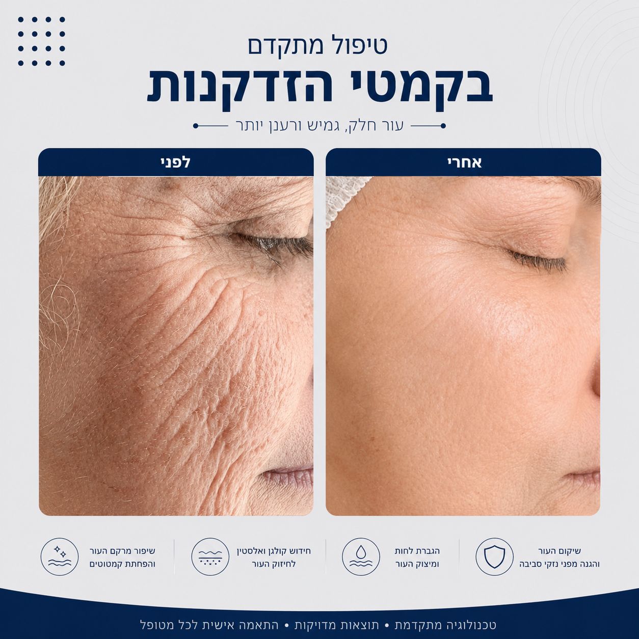 לפני ואחרי טיפול בקמטי הזדקנות - Beauty Hightech